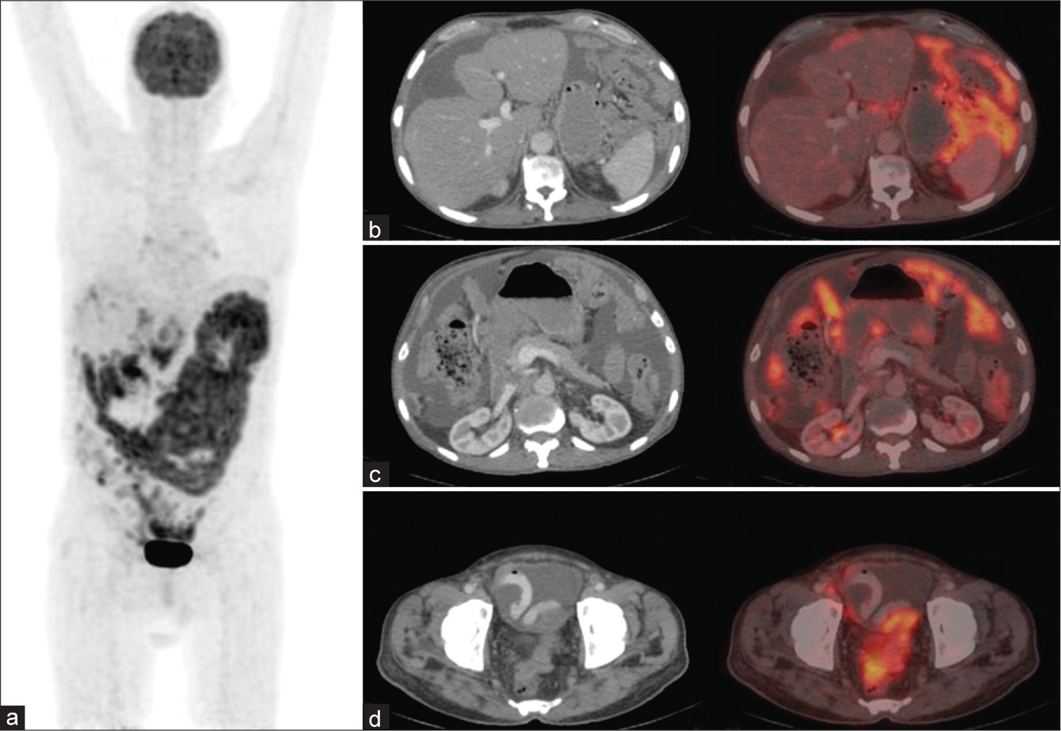 (a) The MIP image of 18F fluorodeoxyglucose positron emission tomography-computed tomography (PET-CT) scan showing diffuse peritoneal carcinomatosis. (b,c,d) shows axial CT and fused PET-CT images of diffuse peritoneal and omental thickening, serosal soft tissue deposits, lymphadenopathy, and ascites. (b and c) Gallbladder and pancreas appear unremarkable