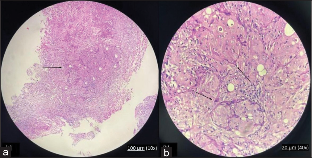 Histopathology images (stained with Hematoxylin & Eosin) of peritoneal mesothelioma (a) 10x (marked with arrow), (b) 40x. Sections studied show tumor tissue arranged in tubular, papillary and solid pattern, at places deciduoid cells are also seen ( marked with arrow). The cells show vesicular and prominent nuclei with abundant eosinophilic cytoplasm.