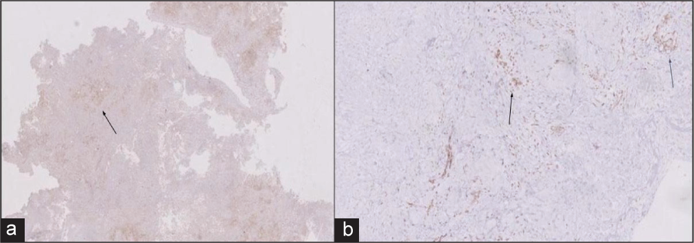 Immunohistochemistry is positive for (a) calretinin and (b) WT1